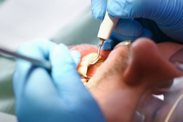 Best Knocked-Out Tooth Emergency  in Berkshire Lakes, FL
